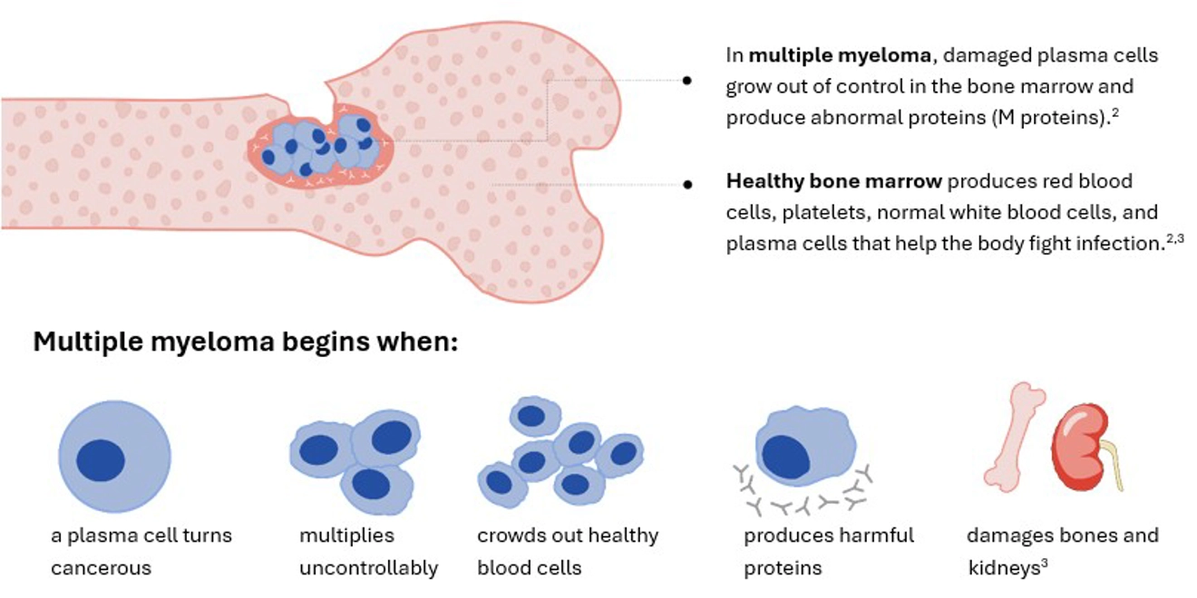 A Visual Guide to Multiple Myeloma- describing the cell formation in the bone marrow.