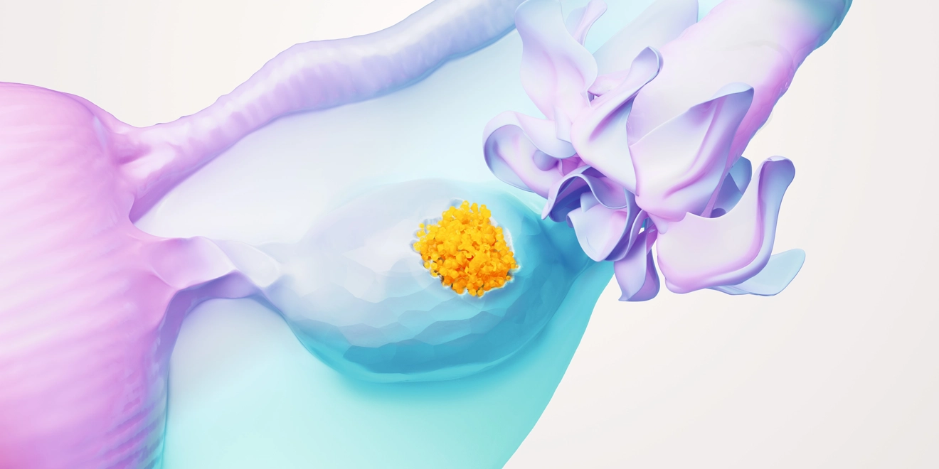 Ovarian Cancer