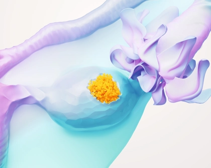 Ovarian Cancer