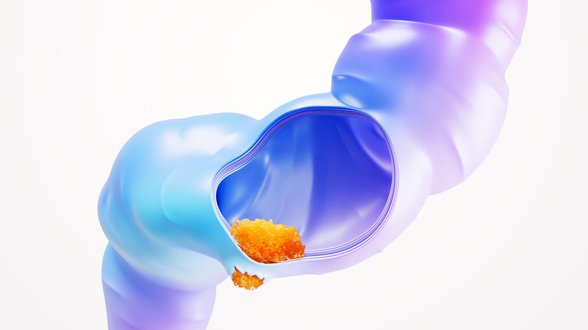 A scientific image of rectal cancer