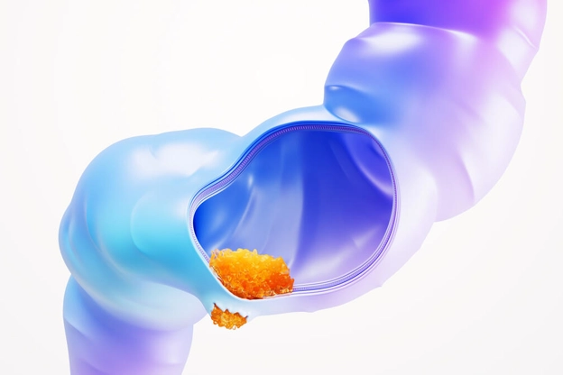 A scientific image of rectal cancer