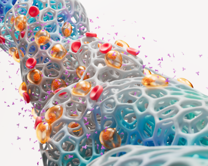 A scientific image of multiple myeloma
